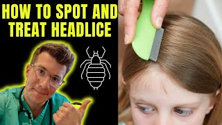 How to spot and treat Head lice nits  Doctor ODonovan explains [upl. by Eeleimaj]