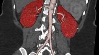 Bilateral renal arterial stenosis [upl. by Eelirak775]