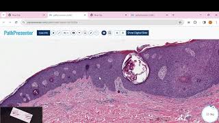 irritated Seborrheic Keratosis [upl. by Nwahsyt926]