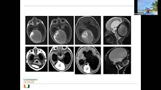 Role of Neuroendovascular Treatment in Intracranial Hypertension and Pseudotumor Cerebri [upl. by Hackathorn]