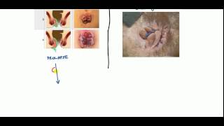 Hemorrhoids Lecture for USMLE [upl. by Roberto]