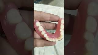 Lower Denture Com for Relining dentures completedentures [upl. by Assin]