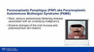 Immunobullous Diseases Paraneoplastic Pemphigus PNPht 2019 04 08 paraeoplatic pemphigus [upl. by Pahl]