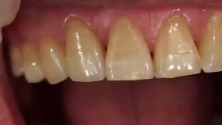 Dental bridge cementation [upl. by Nerahs]