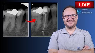 Endo Rtx of 🦷45 with EndoPerio Lesion ▶️ Single Session  CASE168 [upl. by Atiek]