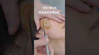 리팟 레이저 다발성 흑자 세종리팟 세종시리팟 reepot lentigo multiplelentigo 청주리팟 공주리팟 대전리팟 오창리팟 오송리팟 부여리팟 [upl. by Lebatsirc]