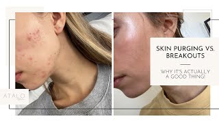 Skin Purging vs Breakouts Whats the Difference [upl. by Noli]