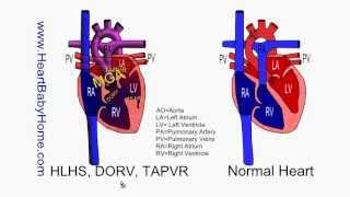 58  HLHS DORV TAPVR with Glenn and Fontan [upl. by Rehtul]