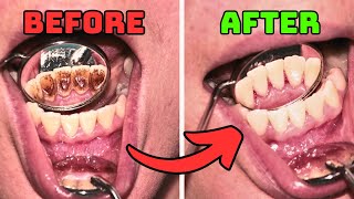 7 Tips to Remove PLAQUE and TARTAR From Teeth Naturally [upl. by Googins]