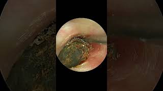 Deep And Stony HARD Earwax Removal Very Satisfying Video [upl. by Lotta]