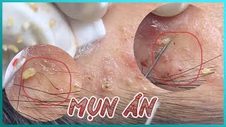 Big Cystic Acne Blackheads Extraction Blackheads amp Milia Whiteheads Removal Pimple Popping [upl. by Earezed797]