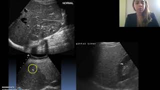 Ecografía de Hígado y Vesícula [upl. by Aggi]