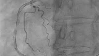 Thrombus aspiration  right coronary artery [upl. by Nesta]