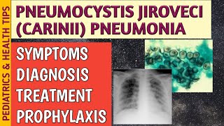 Pneumocystis Jiroveci Pneumonia P Carinii Symptoms Radiology Treatment amp Prophylaxis [upl. by Kcitrap]