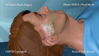 3D MACS e Neck Lift [upl. by Quintus958]