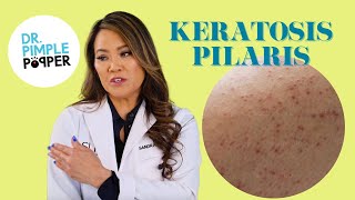 Ask Dr Pimple Popper  Keratosis Pilaris aka Chicken Skin [upl. by Suoiluj]