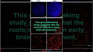 Autism Origins Found in Early Brain Development [upl. by Assirec]