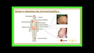 Sintomas de cirrose hepática [upl. by Paryavi]