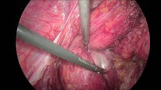 Laparoscopic Excision of a sacrococcygeal teratoma [upl. by Ennaul645]