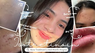 Accutane Journey  Two Months Progress Road to Clear Skin [upl. by Neeoma379]