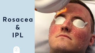 Rosacea Treatment at Pulse Light Clinic London [upl. by Nekciv962]