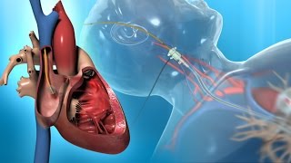 Right Heart Catheter for the Diagnosis of PAH [upl. by Assadah5]