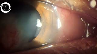 Pedicle conjunctival flap for infectious Keratitis [upl. by Alf236]