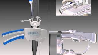 OverStitch™ Animation  Suturing Mechanism [upl. by Asined]