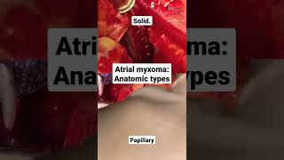 Atrial myxoma anatomic types [upl. by Maril]