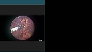 091024 Laparoscopic appendectomy for complicated appendicitis [upl. by Ermentrude]