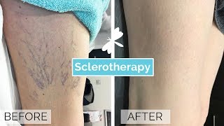 Sclerotherapy Leg Vein Treatment  The Laser and Skin Clinic [upl. by Benedicto]