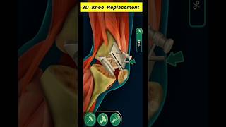 Total Knee Replacement 3D Animationshorts medicaleducation [upl. by Eiryt169]