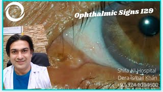 Ophthalmic Signs 129 [upl. by Akeret2]