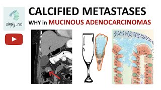 Calcified metastases  mucinous adenocarcinoma [upl. by Annaohj]