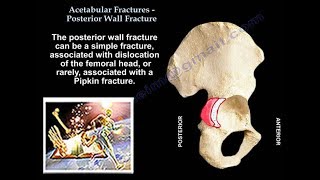 Acetabulum Fracture Posterior Wall Fracture  Everything You Need To Know  Dr Nabil Ebraheim [upl. by Madalyn]