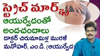 Stretch Marks  Home Remedies  Telugu  Dr Murali Manohar Chirumamilla MD Ayurveda [upl. by Anrim]