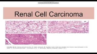 Renal cell carcinoma TypesGeneticsMorphology [upl. by Anrat]