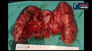 Thyroidectomy Huge Thyroid with compressive symptoms [upl. by Woodcock]