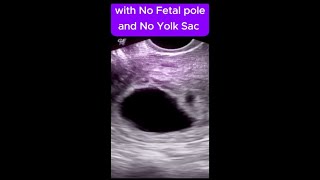 29mm Gestational Sac  No Fetal Pole  Missed Miscarriage [upl. by Cathee781]