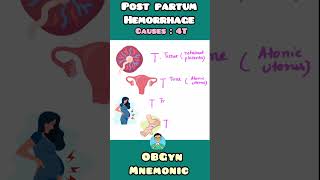 Post Partum Hemorrhage causes explained with easy mnemonic for USMLE NEET PG NCLEX INICET [upl. by Eckart188]