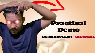 The Ultimate Derma Roller and Minoxidil Tutorial  Practical Video in Hindi [upl. by Ecart]