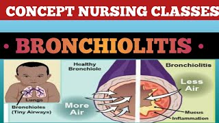 Bronchiolitis causesign symptoms treatment and prevention [upl. by Siubhan]