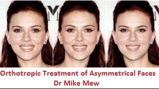 Orthotropics Treatment of Asymmetrical Disproportionate Uneven Faces by Dr MIke Mew [upl. by Sammy762]