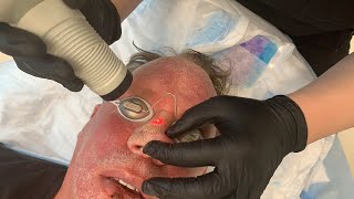 Treating Rhinophyma nose with CO2 Laser  Facial RejuvenationResurfacing Part 3  Dr Jason Emer [upl. by Sokairyk]