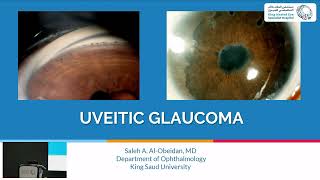 Uveitic Glaucoma [upl. by Asirehc368]