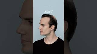 Here’s What Each Hair Loss Stage Looks Like [upl. by Stanwin]