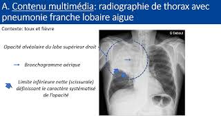 Item 154 Pneumopathie aigue communautaire [upl. by Millman]