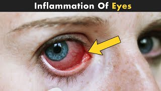 Uveitis  Inflammation Of The Eyes  Causes And Treatment UrduHindi [upl. by Neirrad]