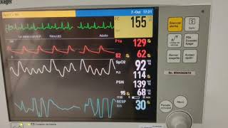 Fibrilación Auricular con RVR Taquicardia Supraventricular  Monitor [upl. by Sola407]