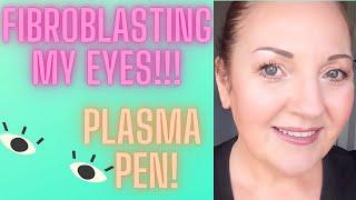 FIBROBLASTING MY EYES PLASMA PEN [upl. by Netsua]